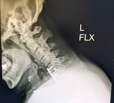 Name:  Neck X-Ray, L-Flex, Jun 2022 - cropped.jpg
Views: 553
Size:  30.2 KB